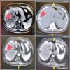 Tratamento contra câncer destrói tumor em 4 minutos em SP.