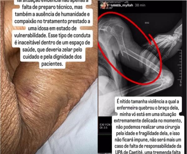 Idosa de 84 anos fratura braço durante atendimento em UPA de Caetité.