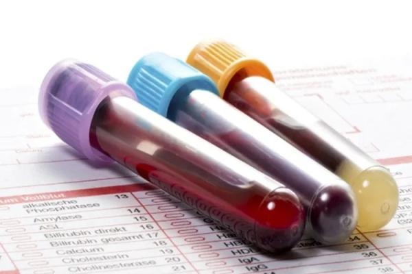 Exame de sangue em teste no Brasil pode ajudar a detectar câncer de mama.